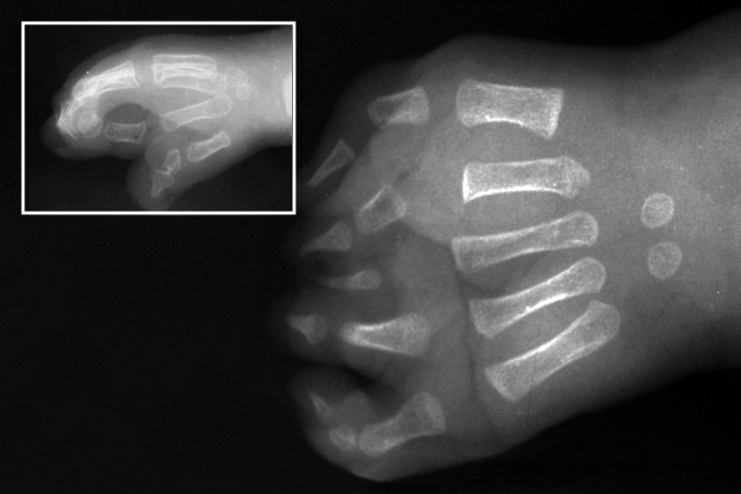 X-ray AP and Lateral views of complex Apert's Syndactyly