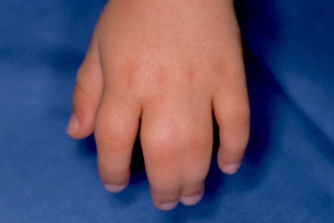 Simple Syndactyly Left Long and Ring Fingers Dorsal view