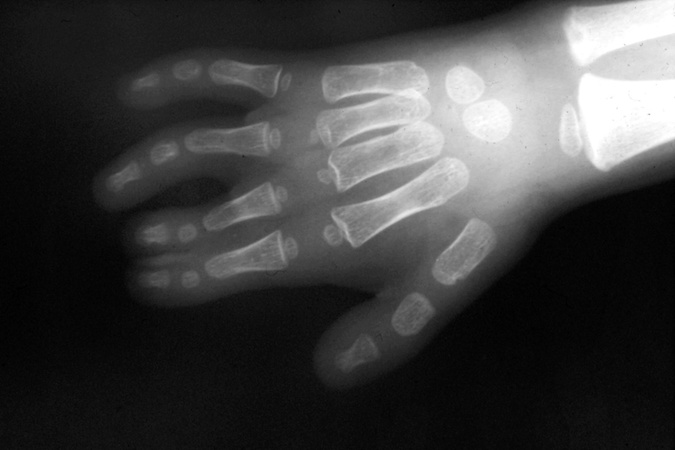 X-ray of left II-III partial simple syndactyly