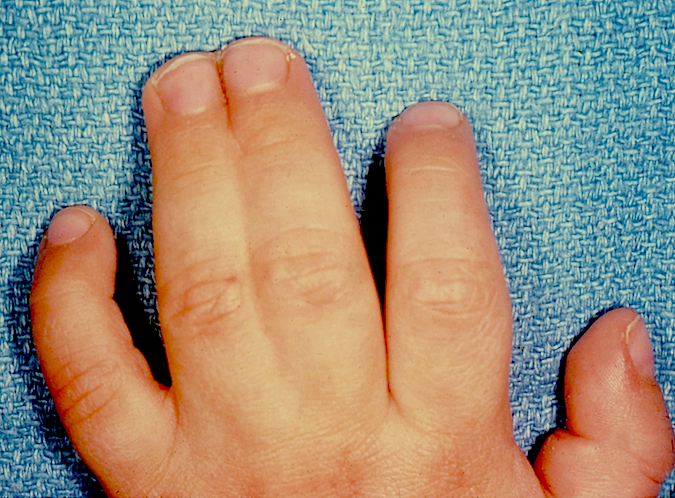 Classic Simple Syndactyly of left long and ring fingers