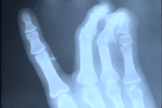 X-ray of right long-ring-liitle complex syndactyly
