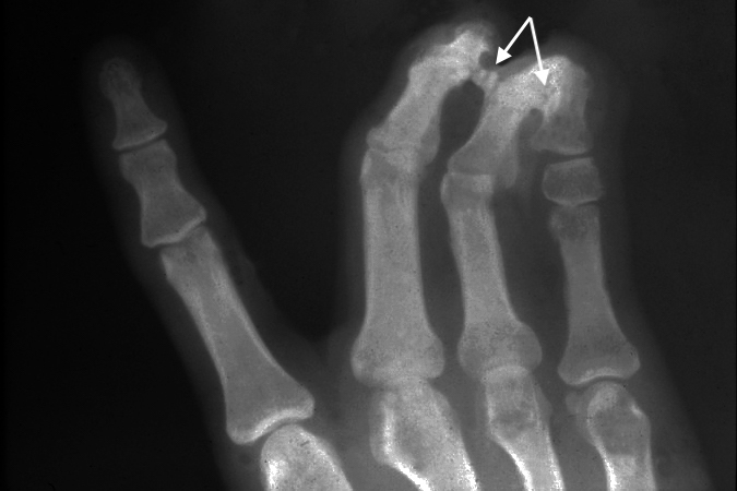 X-ray of right III-IV-V complex (arrows) syndactyly
