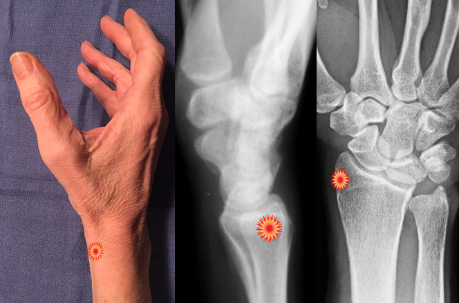The red "tender" sign pin points the area of tenderness in relationship to the lateral distal radius, AP distal radius and the radial wrist surface anatomy of a patient with  DeQuervain's Tenosynovitis.