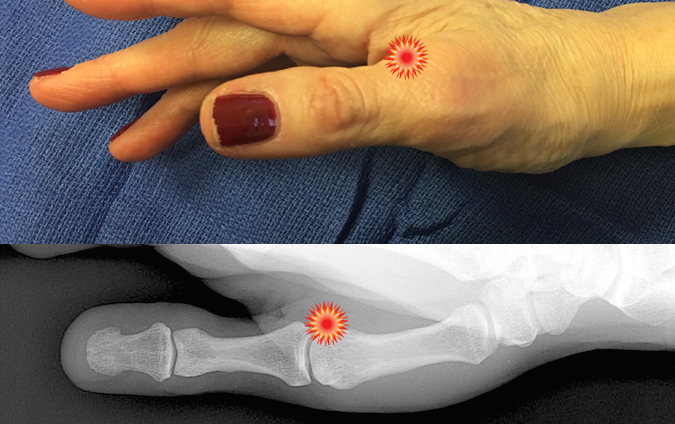 The red "tender" sign pin points the area of tenderness in relationship to the metacarpal, proximal phalanx, MP joint and the surface anatomy of a patient with a Gamekeeper's  thumb injury.