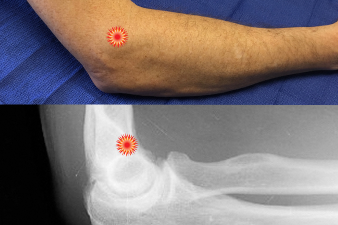 The red "tender" sign pin points the area of tenderness in relationship to the lateral epicondyle and the lateral elbow surface anatomy of a patient with a lateral epicondylitis (Tennis Elbow).