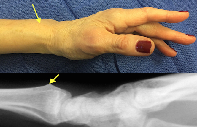 Lister's tubercle (yellow arrow) is a dorsal prominence on the distal radius. This is an easily palpable land mark that is immediate proximal to the S-L joint.