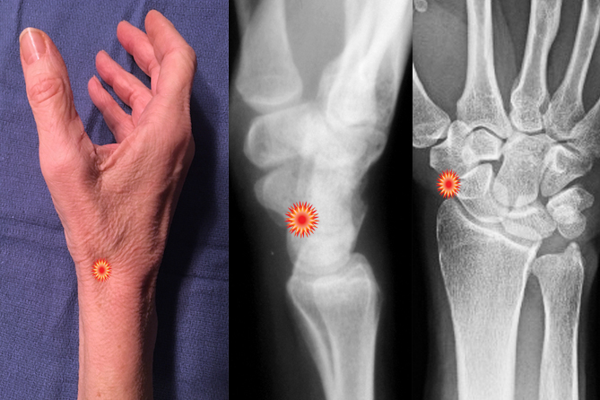 The red "tender" sign pin points the area of tenderness in relationship to the lateral distal radius, AP distal radius and the radial wrist surface anatomy of a patient with a Scaphoid Fracture.