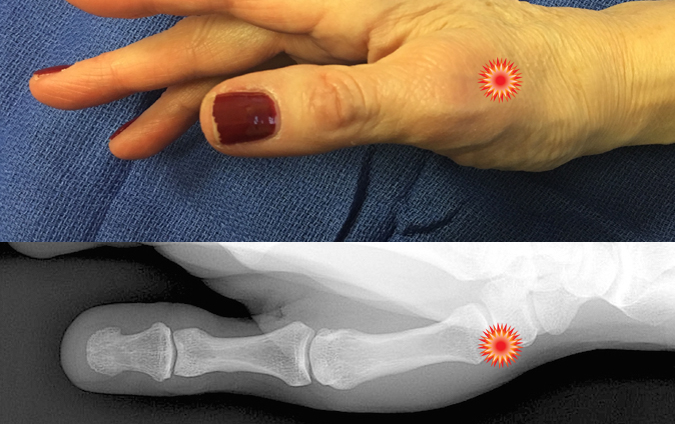 The red "tender"  sign pin points the area of tenderness in relationship to the first metacarpal, trapezium, CMC joint and the surface anatomy of a patient with  thumb CMC OA.