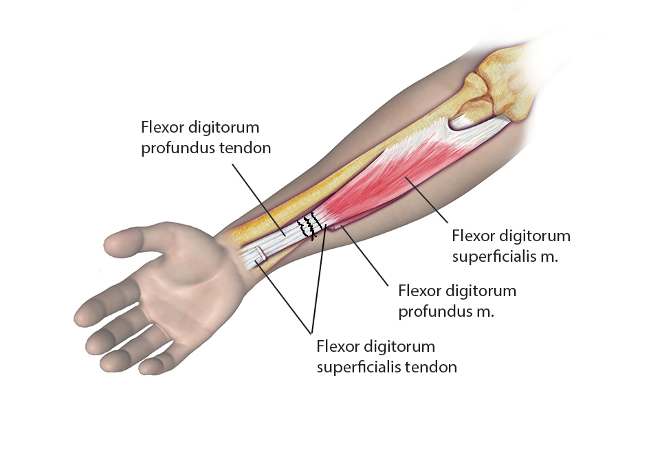 In the second step of the STP Transfer the FDS tendons are sutured to the FDP tendons. Swan neck deformities are avoided by suturing the tendons together while the wrist is in neutral and the MP’s and PIP’s are flexed 45 degrees.