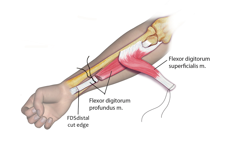 The first step of a Superficialis to Profundus Transfer is to suture all four FDS tendons together and all four FDP tendons together before cutting the FDS tendons distally and the FDP tendons proximally. The FPL ( not shown) requires z-lengthening.