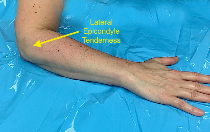 Lateral Epicondylitis (Tennis Elbow)