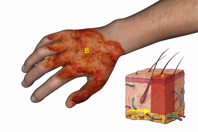 Third degree burn of the dorsum of the hand. Note burn area (B) and depth (arrow). Note this is a full thickness. There will be no associated blanching and no pain because nerve endings have been destroyed.