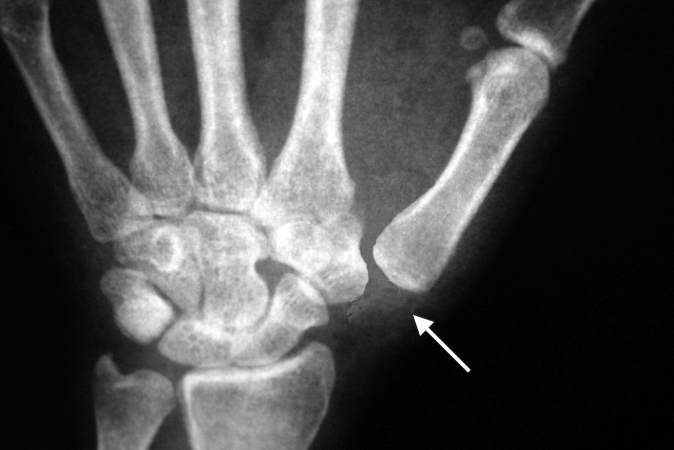 Left thumb CMC dislocation (arrow)