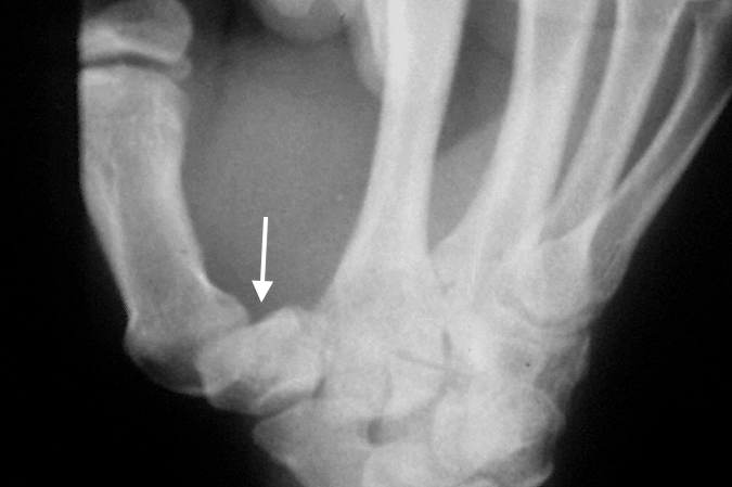 Thumb CMC significant grade II sprain with 50% joint subluxation (arrow)
