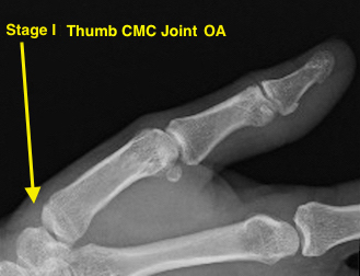 Thumb CMC OA Stage I normal or possible widening of the joint from synovitis and/or joint effusion; joint contours intact