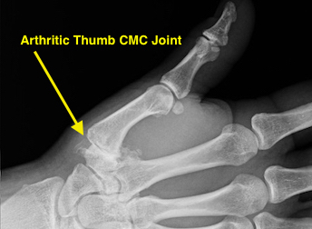Thumb CMC OA Stage III narrow with debris and osteophytes greater than 2 mm; early joint narrowing with thumb CMC joint subluxed more than a third of the joint width