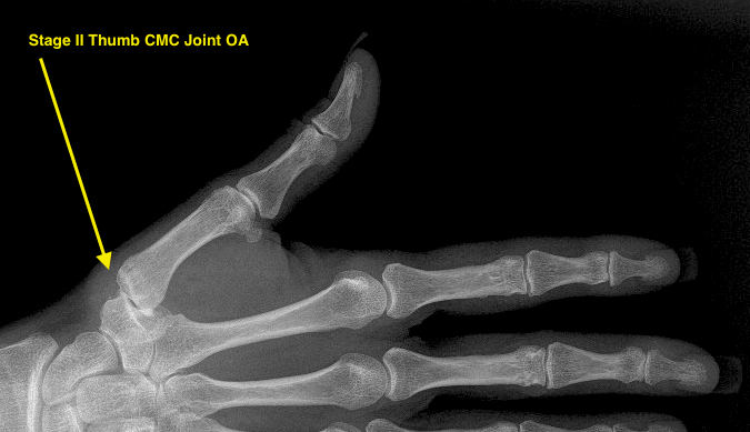 Thumb CMC (Basal Joint) OA Stage II narrow with debris and osteophytes less than 2 mm; minimal joint narrowing with only a few small erosions only; joint subluxed about one-third of joint width