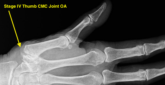 Thumb CMC OA Stage IV severe thumb CMC joint involvement plus scaphotrapezial joint degenerative changes; large osteophytes; possible loose bodies