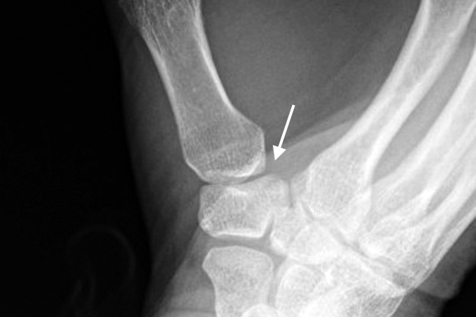 Thumb CMC grade I sprain with mild joint subluxation (arrow)