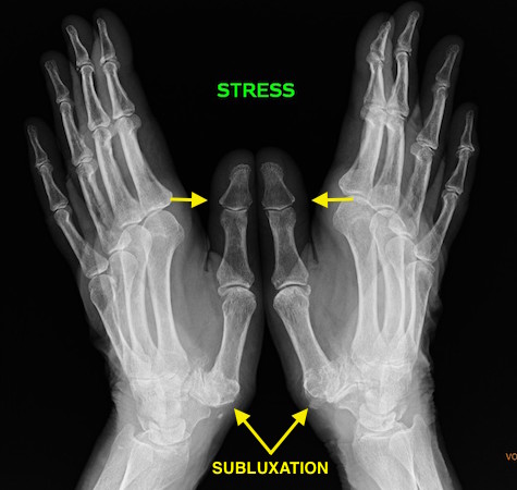 Thumb CMC joint stress X-ray with patient pushing tips of thumbs together forcing the thumb CMC joints to sublux maximally.
