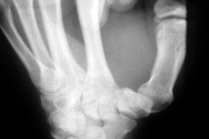 Thumb CMC Dislocation without fracture treated with closed reduction . After cast removed at 6 weeks severe CMC subluxation. Reduction, pinning and cast may have prevent symptomatic subluxation.