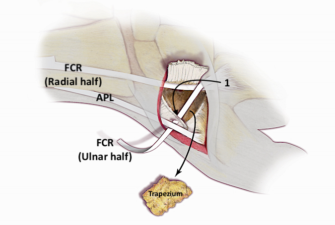 The trapezium has been excised, usually in pieces. The radial half of the FCR is left intact while the ulnar half of the FCR is passed across the defect created by removing the trapezium and then through the dorsal radial corner of the CMC joint capsule (1).  Next the FCR tendon half goes around the abductor pollicis longus at its insertion site at the base of the thumb metacarpal.