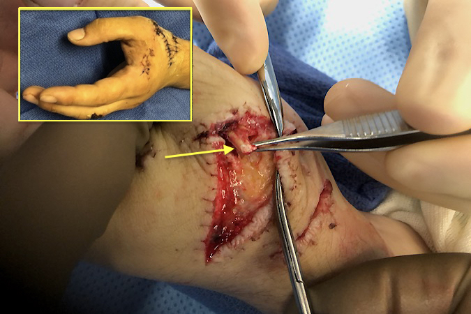 EPL and EPB lacerations secondary to broken glass door injury.  Note distal stump of the EPL (arrow).  Proximal laceration was superficial with no injury to deeper structures.