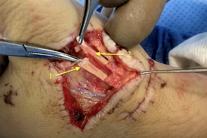 Thumb laceration with proximal EPL (1) and proximal EPB (2) identified before repairs.