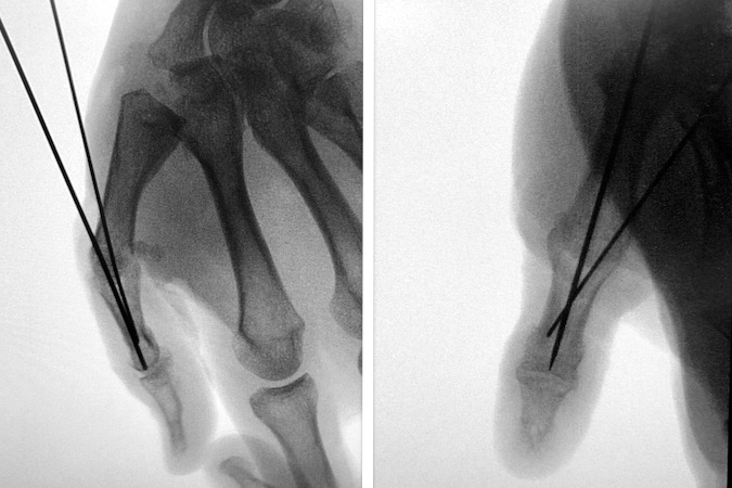 Final X-ray after MP joint fusion.  Note mild flexion position and second K-wire to add fixation and rotational control in this case.