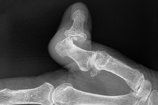 Elderly male with a left thumb acute IP dislocation