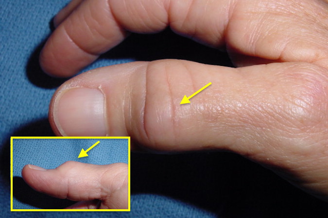 OA left thumb IP joint.  Note joint dorsal deformity (arrows).