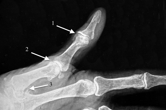 Thumb OA of the IP joint (1), MP joint (2) and CMC joint (3).