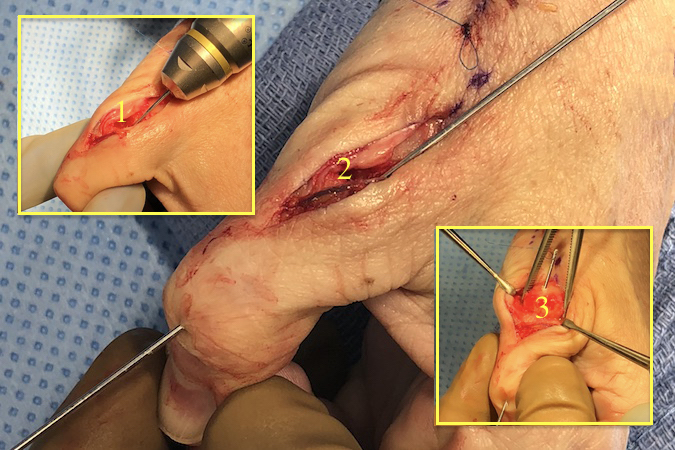 Metacarpal head fitted and compressed into the base of the proximal phalanx and secured with two K-wires.  First K-wire passed retrograde into IP joint, then ante-grade into the head and final through the dorsal metacarpal shaft cortex. (1-3)