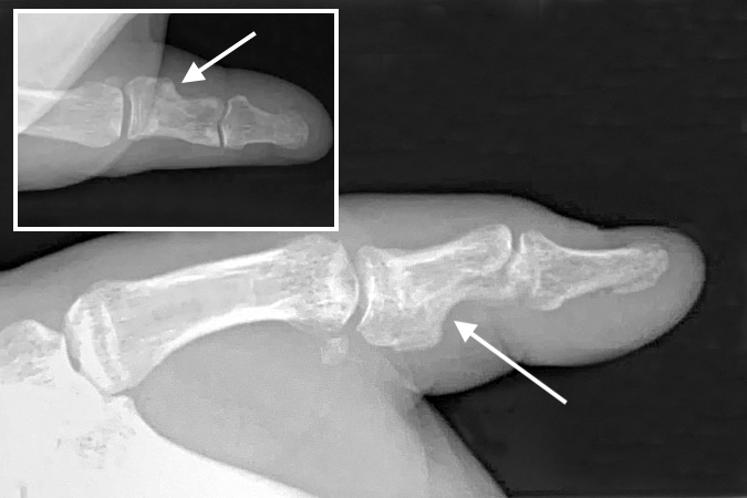  Lateral & AP thumb X-ray of open proximal phalanx fracture after several months of healing and remodeling (arrow).