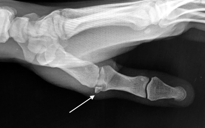 Thumb intraarticular radial collateral avulsion fracture with malrotation
