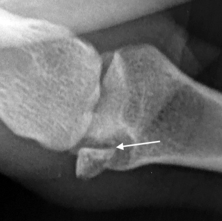 Thumb intraarticular radial collateral avulsion fracture with cartilage surface rotated into the fracture site (arrow).