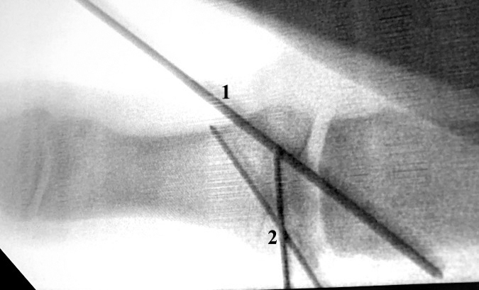 Thumb intraarticular radial collateral avulsion fracture fixation AP view:  (1) Pin immobilizing MP joint; (2) Pins for internal fixation of fragment