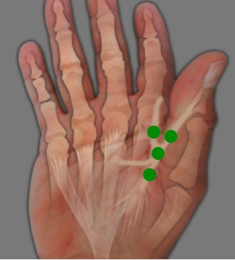 Commissural cord, Adductor cord and radial cord of the thumb which moves the thumb into the palm, contracts the first web and creates a thumb MP flexion contracture.