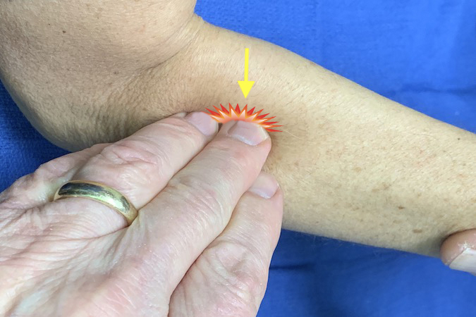 Taping over the proximal radial nerve to elicit a positive Tinel's Sign associated with radial nerve entrapment.  Even with PIN Palsy this Tinel's sign can produce a false negative finding.