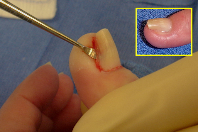 Nail being removed to expose sterile matrix which will be opened to expose distal phalanx.