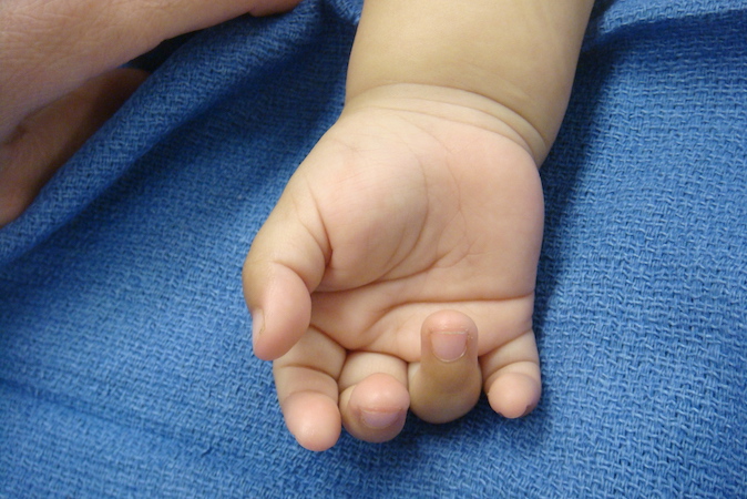 Trigger fingers also occur in children.  Toddler with right ring chronic trigger finger locked in mild flexion.
