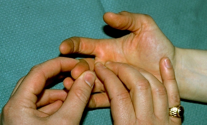 Palpating for A-1 flexor tendon pulley right long finger for tenderness