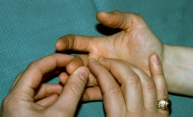 Right Long Trigger Finger Exam - Examiner is palpating A-1 pulley while passively flexing and extending the finger. Palpation should reveal tenderness and/or crepitus as the flexor tendon moves through the A-1 pulley.