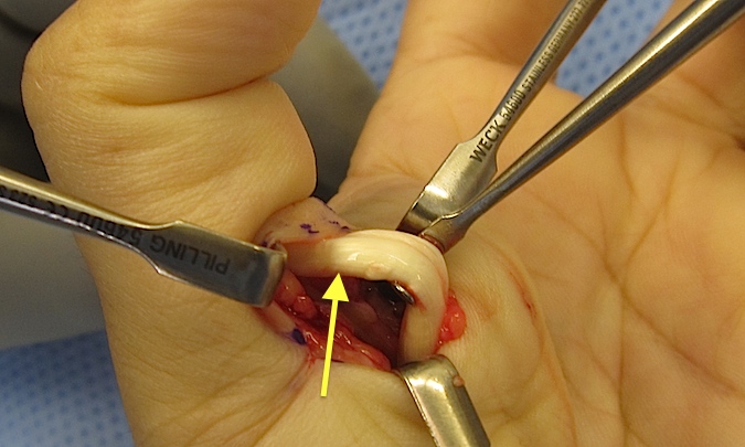 Trigger Thumb - Arrow separates "Notta's" section proximally from normal FPL distal to A-1 constriction.