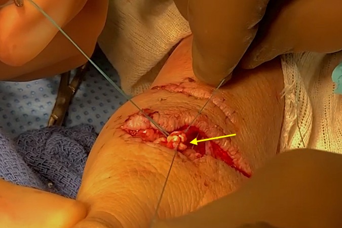 Core suture in the EPL being tied.  Note some tension being applied to prevent post-operative gapping.  Some bunching noted bot this will be improved with the epitendinous edge suture and will be tolerated in this subcutaneous location.
