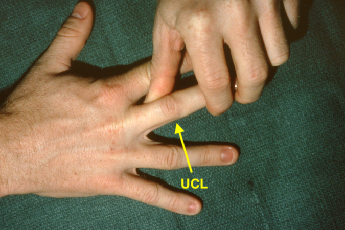 Testing ulnar collateral ligament (UCL) stability after closed reduction right long finger PIP dislocation under local block.
