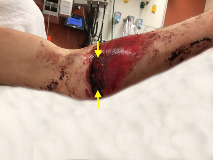 Acute ulnar nerve laceration secondary to an MVA.  Note deep large laceration (arrows) in the proximal ulnar forearm.