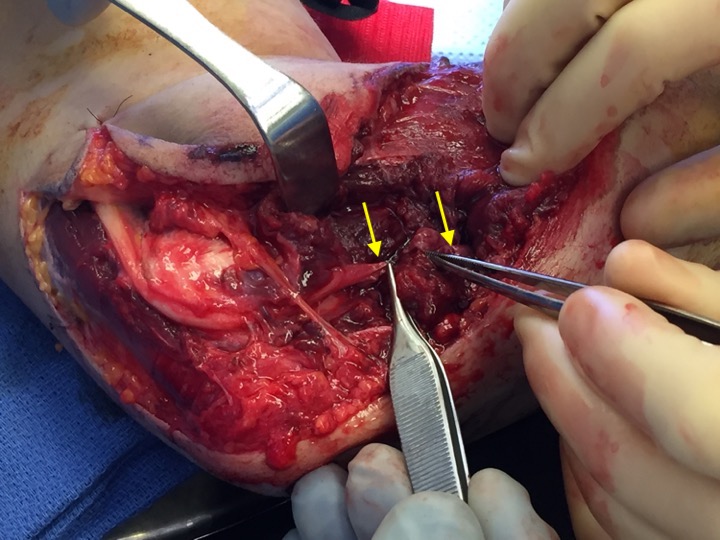 Ulnar nerve has been surgical exposed.  Note the nerve gap between the arrows.  This ulnar nerve laceration will have be repaired with an anterior transposition of the ulnar nerve and may require nerve grafting or a conduit.
