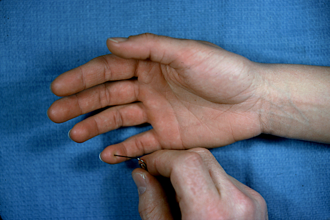 Testing sensation in a patient with a mid-forearm ulnar nerve laceration.