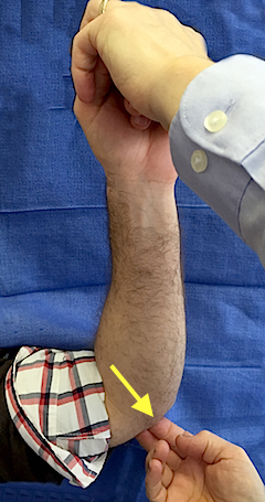 Eliciting Ulnar tinel's sign in ulnar groove at elbow just posterior to medial epicondyle (arrow).